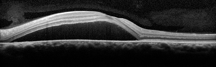 OCT image of central serous chorioretinopathy, showing fluid under the macula