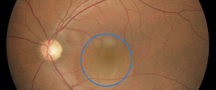 Photo of the back of an eye with central serous chorioretinopathy. A circle shows area of fluid accumulation.