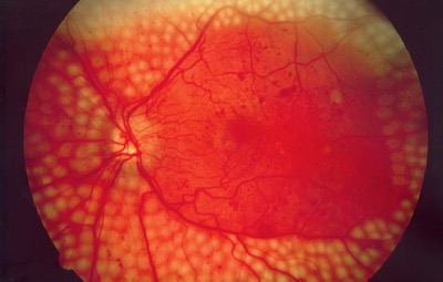 Eye with diabetic retinopathy, treated with laser