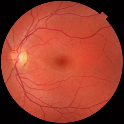 Medical image of healthy eye