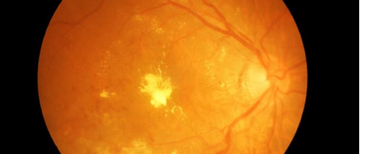 Image of the back of an eye with diabetic retinopathy.