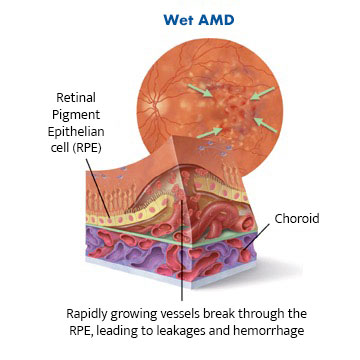 Image shows diagram of cross section of retina with wet AMD showing rapidly growing vessels breaking through the RPE, leading to leakages and haemorrhage