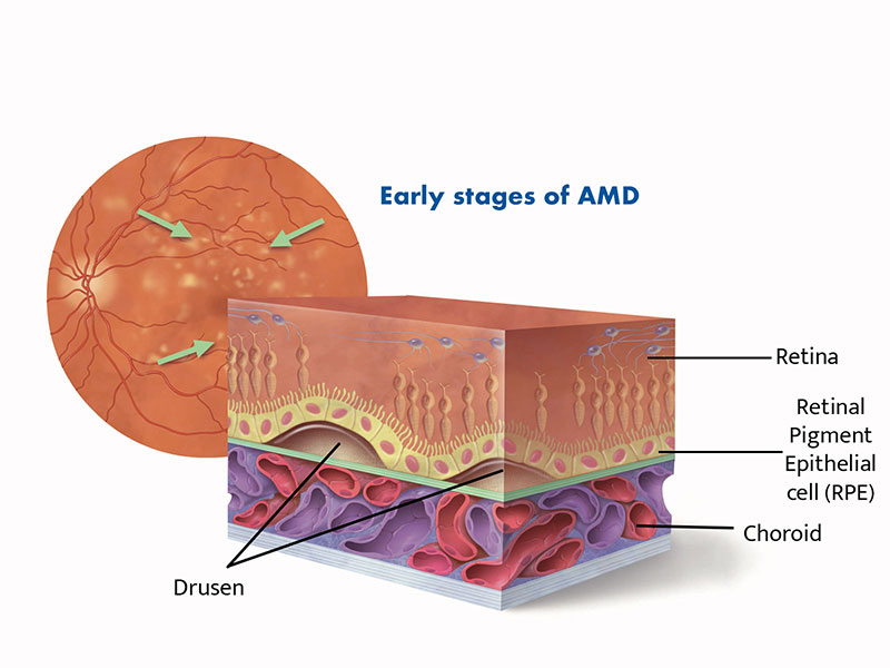 Diagram of cross section of retina showing drusen developing in early age-related macular degeneration