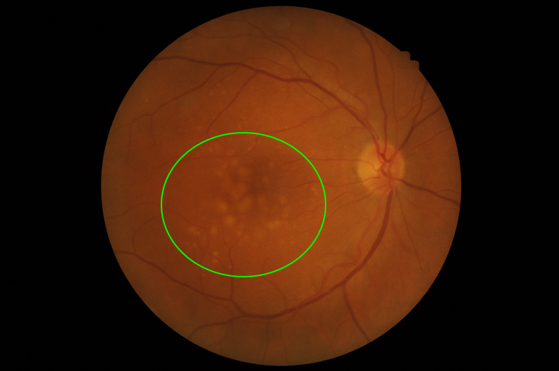 Image of the retina, with areas of drusen highlighted by a green circle.