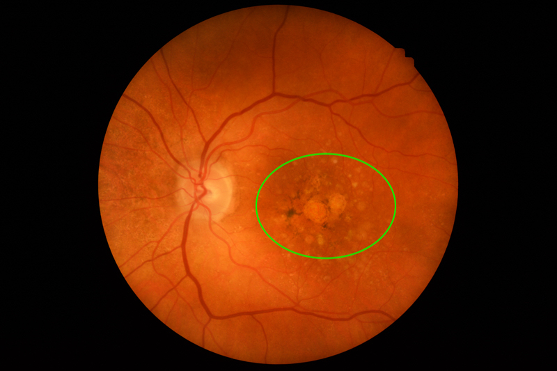 Image of the retina with wet AMD. Areas of drusen are highlighted by a green circle.