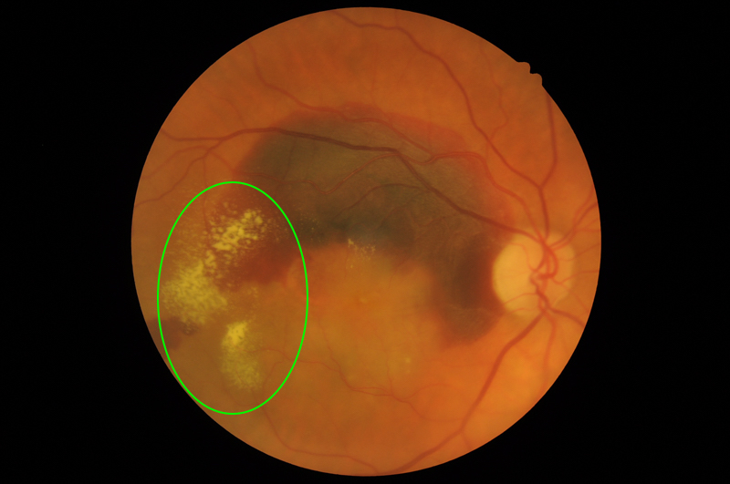 Image of the retina with wet AMD. Areas of drusen are highlighted by a green circle while the retinal bleed appears as a dark patch on the retina.