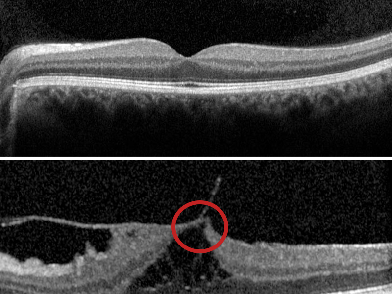 The image shows two OCT scans. The top image is of a healthy retina. The bottom image shows vitro macular traction syndrome, as highlighted by the red circle. 